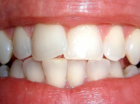 Die richtige Zahnfüllung wählen